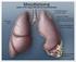 What is Mesothelioma? Mesothelioma is a cancer of the lining of the lung or the abdomen caused by asbestos.