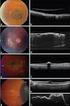 CLINICAL SCIENCES. Enhanced Depth Imaging Optical Coherence Tomography of Small Choroidal Melanoma