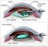 Cataract and Cataract Surgery