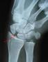 Injury to the Scapholunate Ligament in Sport A Case Report