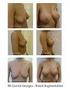 Breast Anatomy. Patient Information on Breast Augmentation Surgery