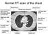Normal CT scan of the chest