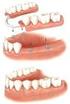 Implant Assisted Removable Prosthodontics
