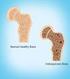 Fast Facts on Osteoporosis