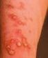 Cutaneous Fungal Infections