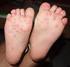 Hand-foot-and-mouth Disease