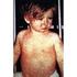 Measles Disease: Q & A