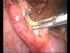 Interval Appendectomy